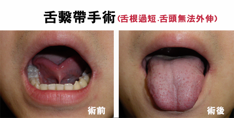 舌繫帶手術2020 86